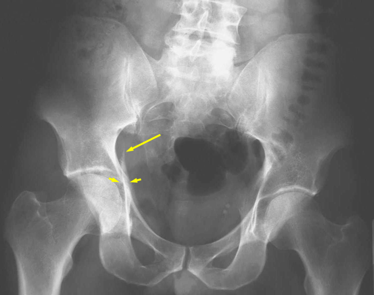 acetabular-fractures-trauma-orthobullets